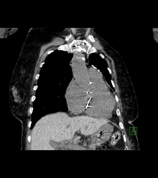 File:Amiodarone deposition in the liver (Radiopaedia 77587-89780 Coronal non-contrast 27).jpg
