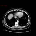 Ampullary carcinoma (Radiopaedia 56396-63056 C 11).jpg