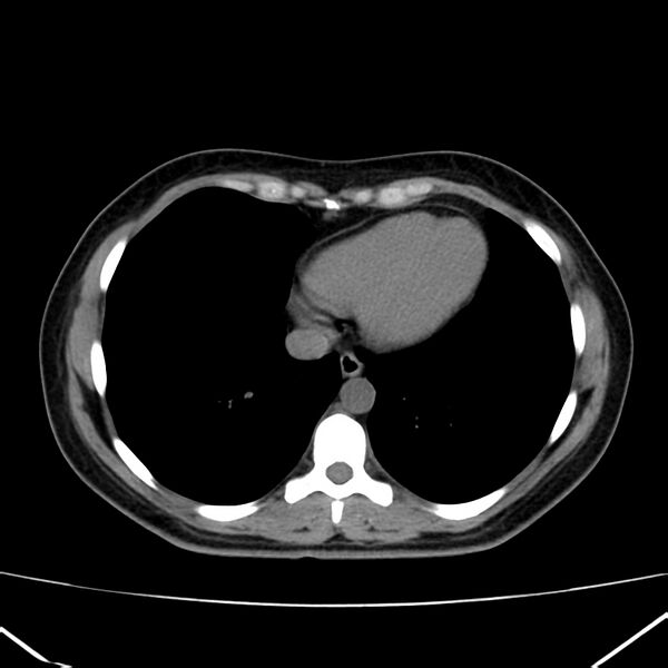 File:Ampullary tumor (Radiopaedia 22787-22816 Axial non-contrast 2).jpg