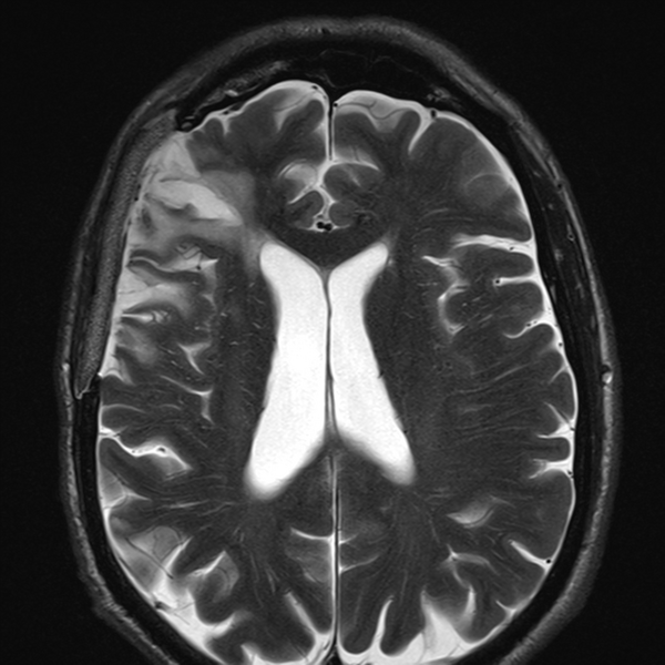 File:Anaplastic meningioma with recurrence (Radiopaedia 34452-35788 Axial T2 16).png
