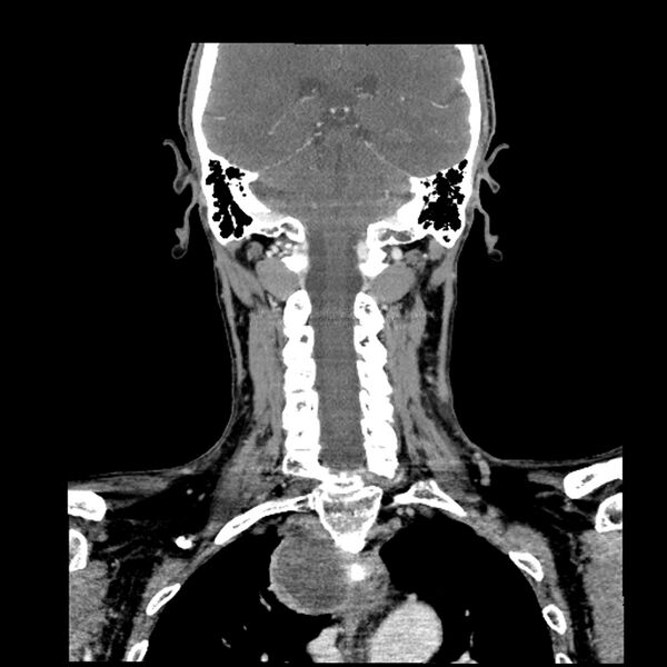 File:Anaplastic thyroid carcinoma (Radiopaedia 79087-92034 A 81).jpg