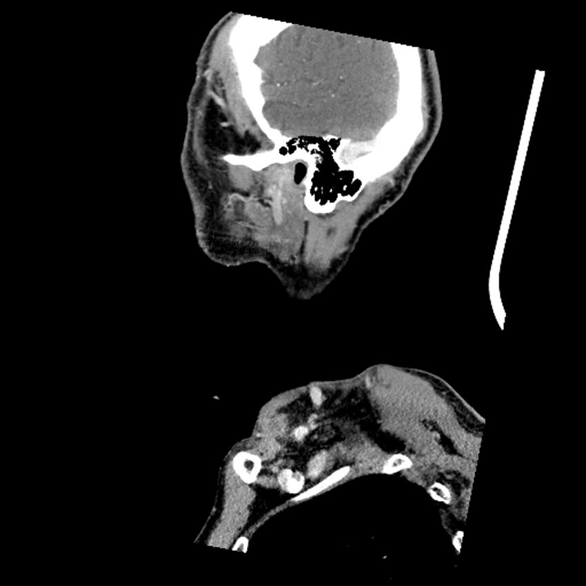 Anaplastic thyroid carcinoma (Radiopaedia 79087-92034 C 16).jpg