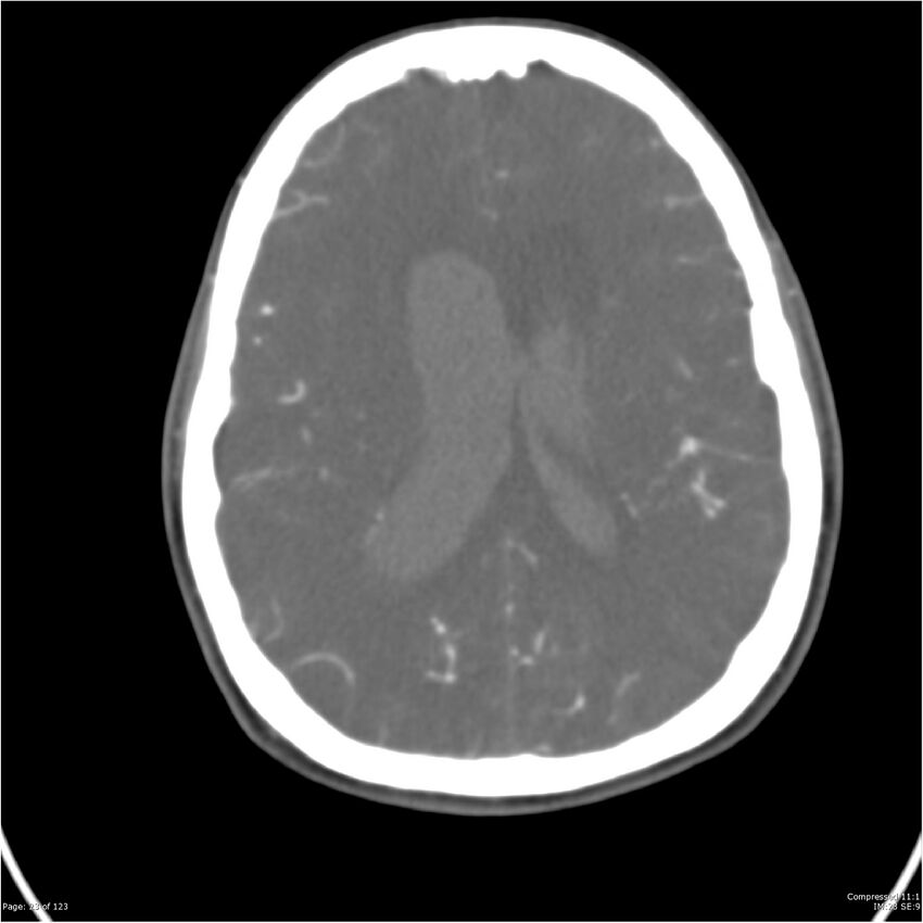 Aneurysmal subarachnoid hemorrhage and Moya Moya disease (Radiopaedia 34306-35593 Axial CT COW 23).jpg