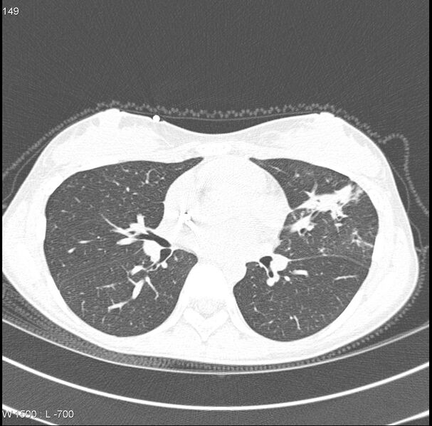 File:Angioinvasive aspergillosis (Radiopaedia 8651-15074 Axial lung window 6).jpg