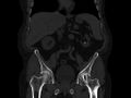 Ankylosing spondylitis (Radiopaedia 44609-48357 Coronal bone window 27).jpg
