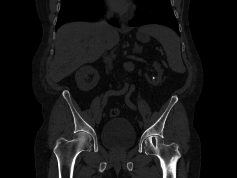 File:Ankylosing spondylitis (Radiopaedia 44609-48357 Coronal bone window 27).jpg