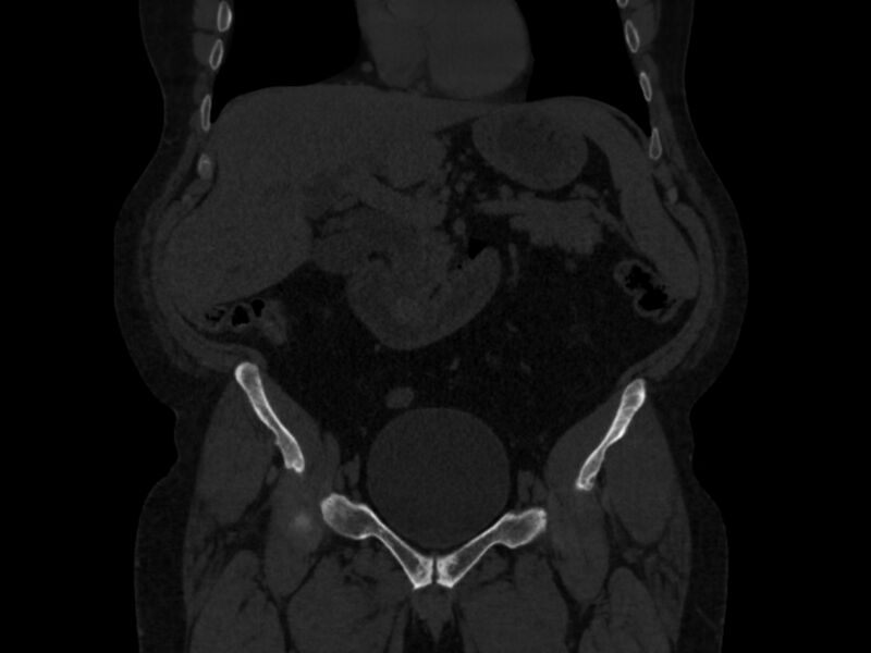 File:Ankylosing spondylitis (Radiopaedia 44609-48357 Coronal bone window 9).jpg