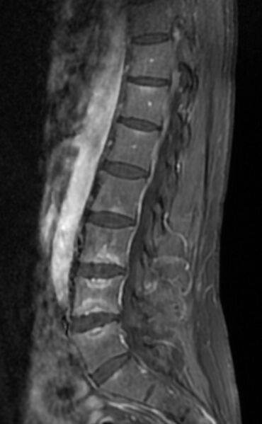 File:Ankylosing spondylitis - Andersson lesion (Radiopaedia 81878-95838 F 8).jpg