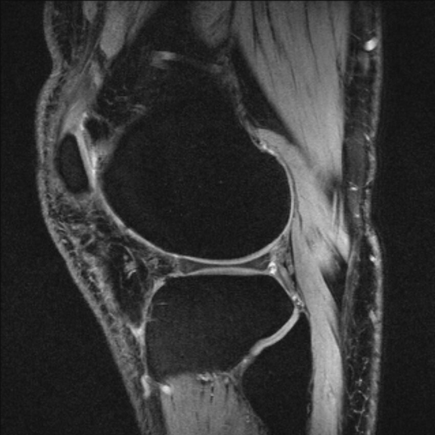 Anterior cruciate ligament mucoid degeneration (Radiopaedia 68400-77933 Sagittal 13).jpg