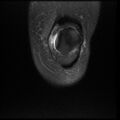 Anterior cruciate ligament tear, Wrisberg rip and bucket-handle tear of medial meniscus (Radiopaedia 75872-87266 Coronal PD fat sat 4).jpg