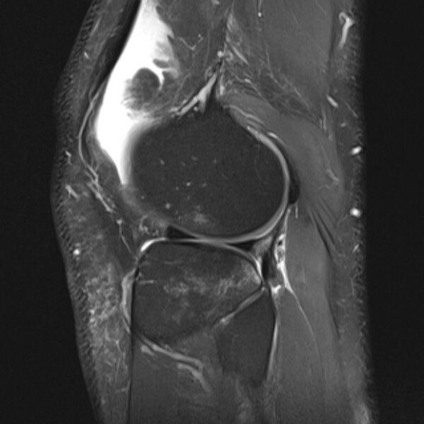 File:Anterior cruciate ligament tear - ramp lesion (Radiopaedia 71883-82322 Sagittal PD fat sat 6).jpg