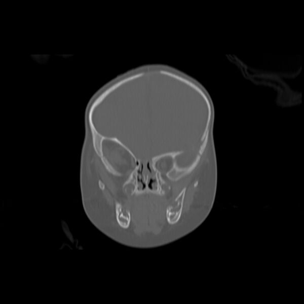 File:Anterior plagiocephaly (Radiopaedia 71836-82273 Coronal bone window 9).jpg