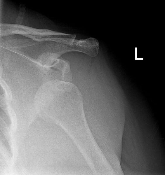 File:Anterior shoulder dislocation (Radiopaedia 55849-62434 Frontal 1).jpg