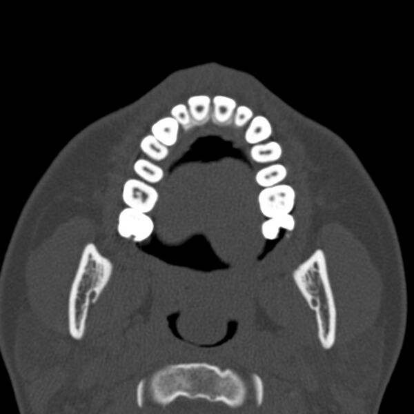 File:Antrochoanal polyp (Radiopaedia 21894-21868 Axial bone window 2).jpg