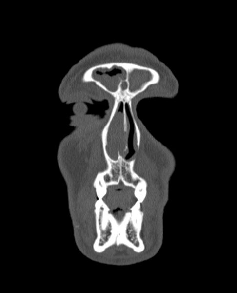 File:Antrochoanal polyp (Radiopaedia 79011-92169 Coronal bone window 79).jpg