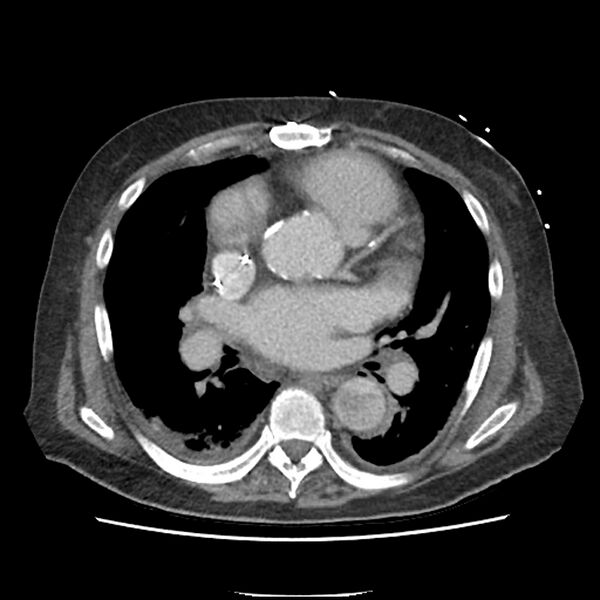 File:Aortic arch graft infection (FDG PET-CT) (Radiopaedia 71975-82437 A 30).jpg