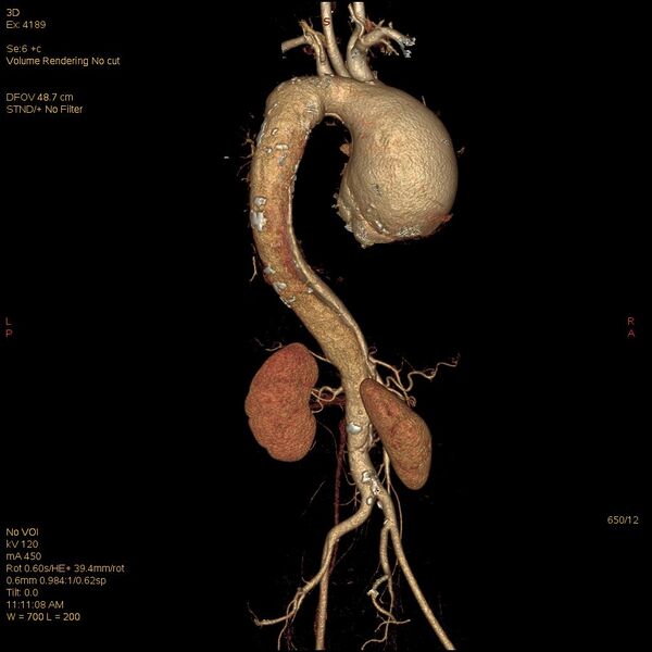 File:Aortic dissection (Radiopaedia 25350-25604 E 12).jpg