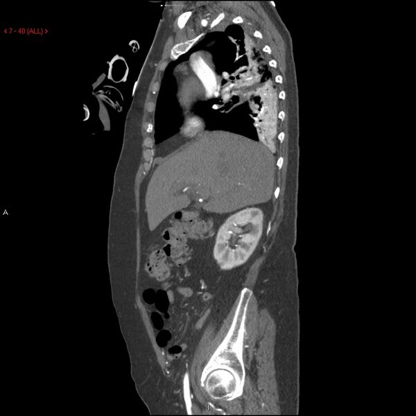 File:Aortic intramural hematoma (Radiopaedia 27746-28001 C 9).jpg