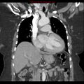 Aortic valve stenosis (Radiopaedia 14480-14423 A 11).jpg