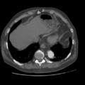Aorto-coronary bypass graft aneurysms (Radiopaedia 40562-43157 A 100).png