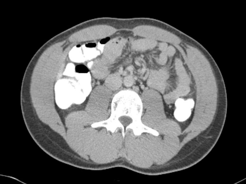 Appendicitis and incidental foregut duplication cyst (Radiopaedia 52962-58916 A 33).jpg