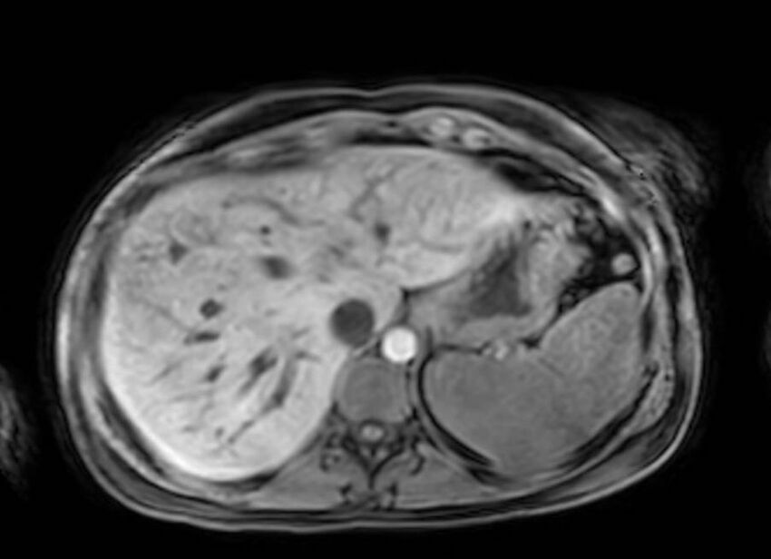 Appendicitis in gravida (MRI) (Radiopaedia 89433-106395 Axial DIXON 15).jpg