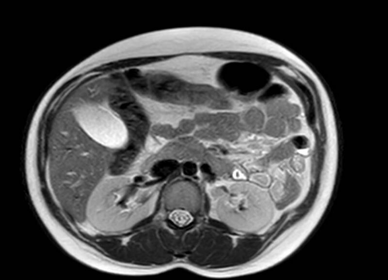 File:Appendicitis in gravida (MRI) (Radiopaedia 89433-106395 Axial T2 23).jpg