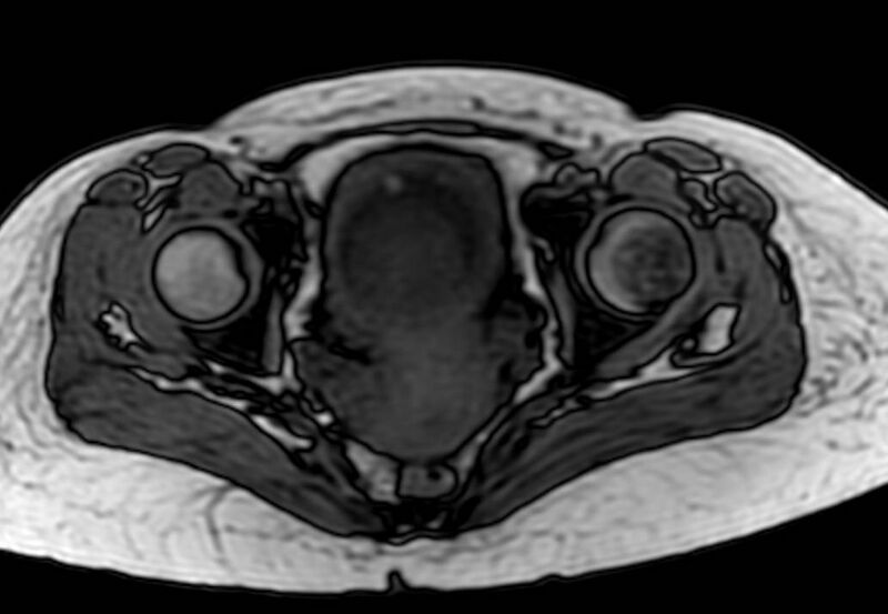 File:Appendicitis in gravida (MRI) (Radiopaedia 89433-106395 D 65).jpg