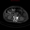 Arachnoiditis ossificans (Radiopaedia 51394-57136 Axial bone window 17).jpg