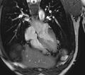 Arrhythmogenic right ventricular cardiomyopathy (Radiopaedia 39806-42237 D 115).jpg