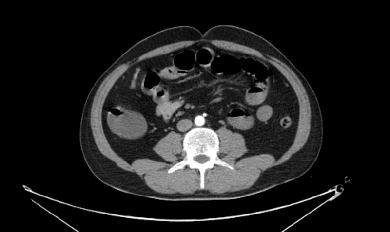 File:Arterial occlusive mesenteric ischemia (Radiopaedia 84641-100060 A 74).jpg