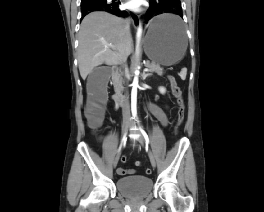 Arterial occlusive mesenteric ischemia (Radiopaedia 84641-100060 B 30).jpg