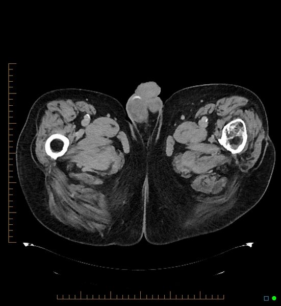 File:Artificial urethral sphincter (Radiopaedia 46937-51464 A 18).jpg
