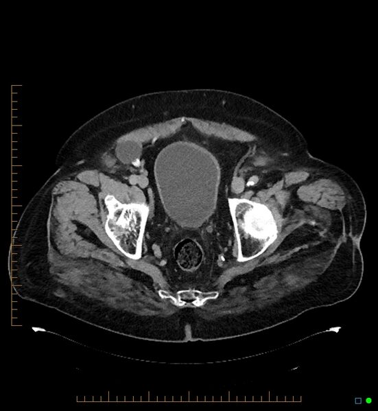 File:Artificial urethral sphincter (Radiopaedia 46937-51464 A 5).jpg