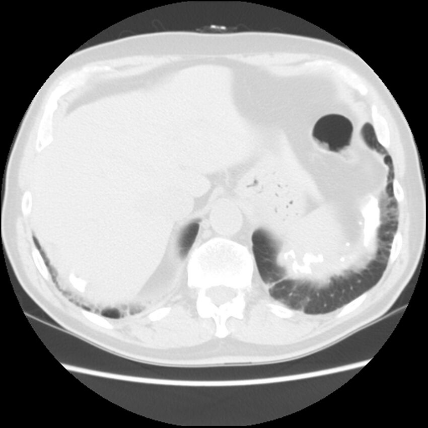 Asbestos-related pleural plaques (Radiopaedia 39069-41255 Axial lung window 64).jpg