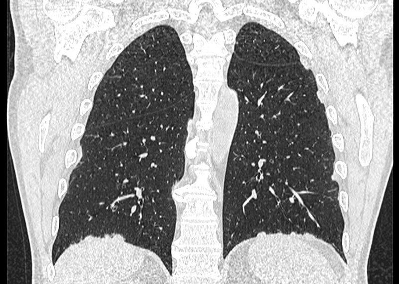 File:Asbestos pleural placques (Radiopaedia 57905-64872 Coronal lung window 212).jpg