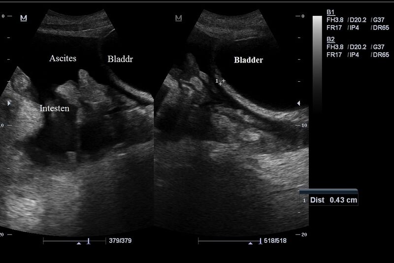 File:Ascites with bilateral pleural effusions (Radiopaedia 26151-26288 C 1).JPG