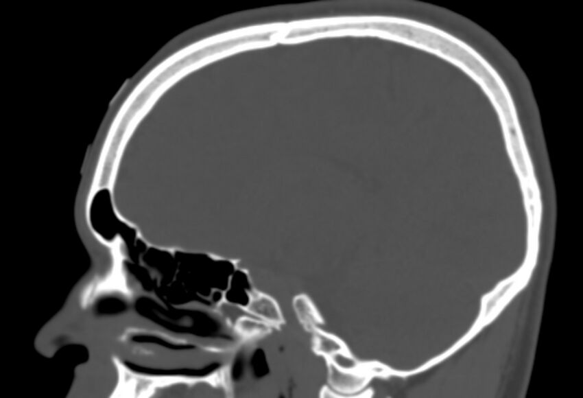 Asymptomatic occipital spur (Radiopaedia 87753-104201 Sagittal bone window 124).jpg