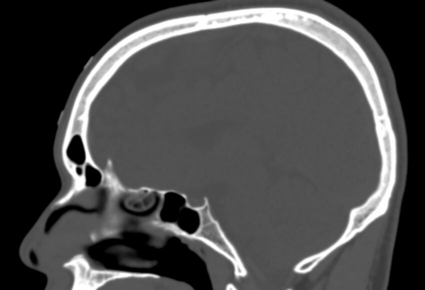 Asymptomatic occipital spur (Radiopaedia 87753-104201 Sagittal bone window 145).jpg