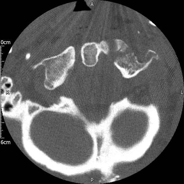 File:Atlas fracture with Currarino type A congenital defect (Radiopaedia 71747-82144 Axial bone window 35).jpg