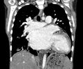 Atrial septal defect complicated by Eisenmenger syndrome (Radiopaedia 53707-59768 Coronal C+ CTPA 13).jpg