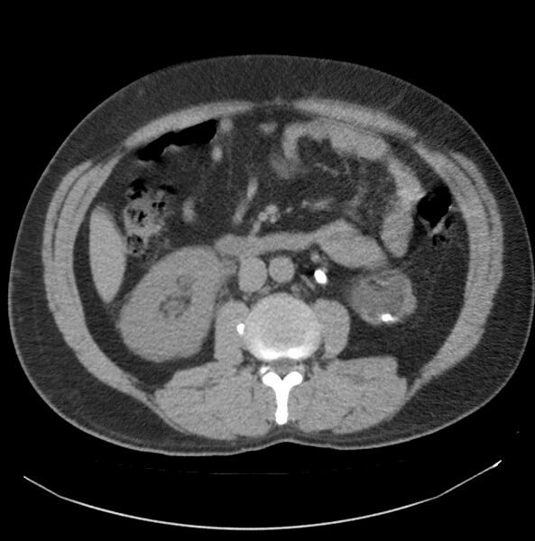 File:Atrophic kidney due to severe chronic obstructive hydronephrosis (Radiopaedia 40828-43474 Axial non-contrast 10).jpg