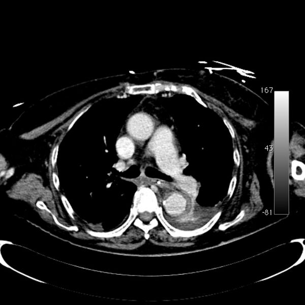 File:Atypical dissection of the thoracic aorta (Radiopaedia 10975-78320 A 25).jpg