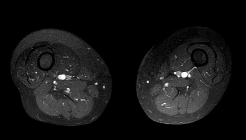 Atypical lipomatous tumor - thigh (Radiopaedia 68975-78734 Axial T1 C+ fat sat 39).jpg