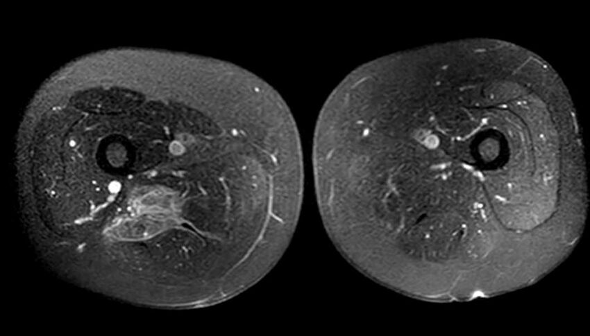 Atypical lipomatous tumor - thigh (Radiopaedia 68975-78734 Axial T1 C+ fat sat 57).jpg