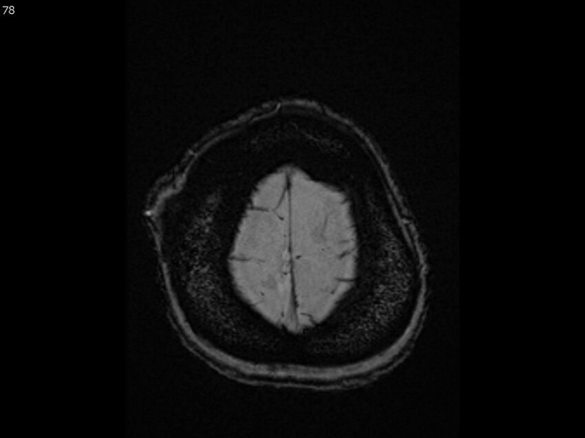 Atypical meningioma - intraosseous (Radiopaedia 64915-74572 Axial SWI 78).jpg