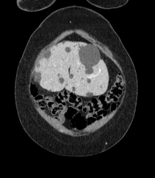 File:Autosomal dominant polycystic kidney disease (Radiopaedia 57124-64017 B 8).jpg