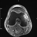 Avulsion fracture of the fibular head (Radiopaedia 74804-85808 Axial PD fat sat 18).jpg