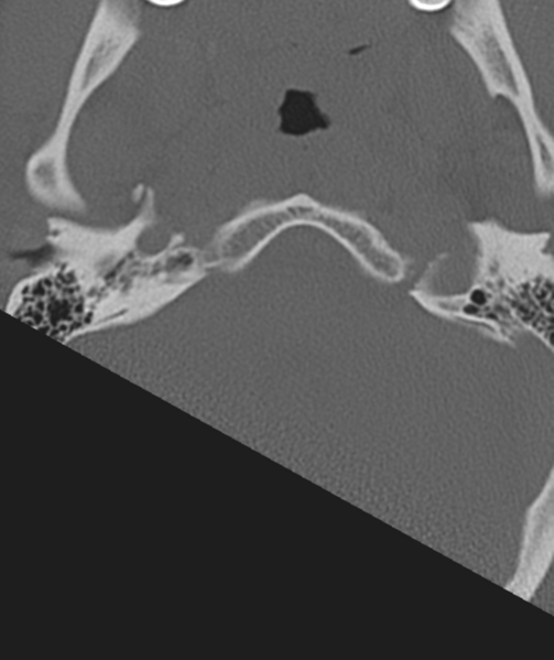 File:Axis peg fracture (type 3) and atlas lateral mass (type 4) fracture (Radiopaedia 37474-39324 Axial bone window 3).png