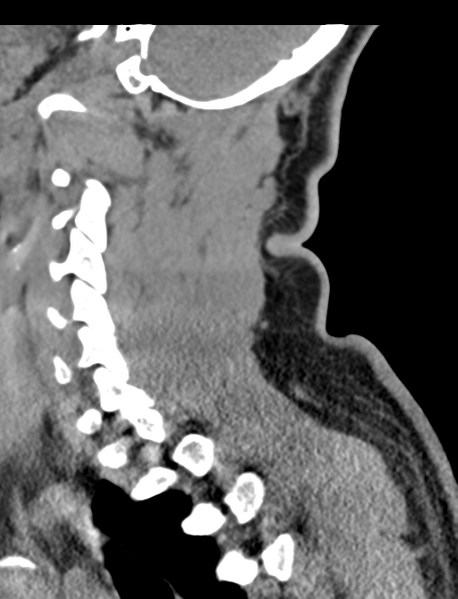 File:Axis peg fracture (type 3) and atlas lateral mass (type 4) fracture (Radiopaedia 37474-39324 D 54).png